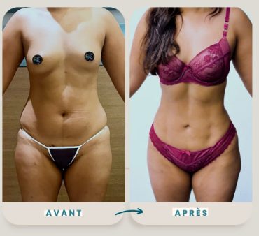 Abdominoplastie