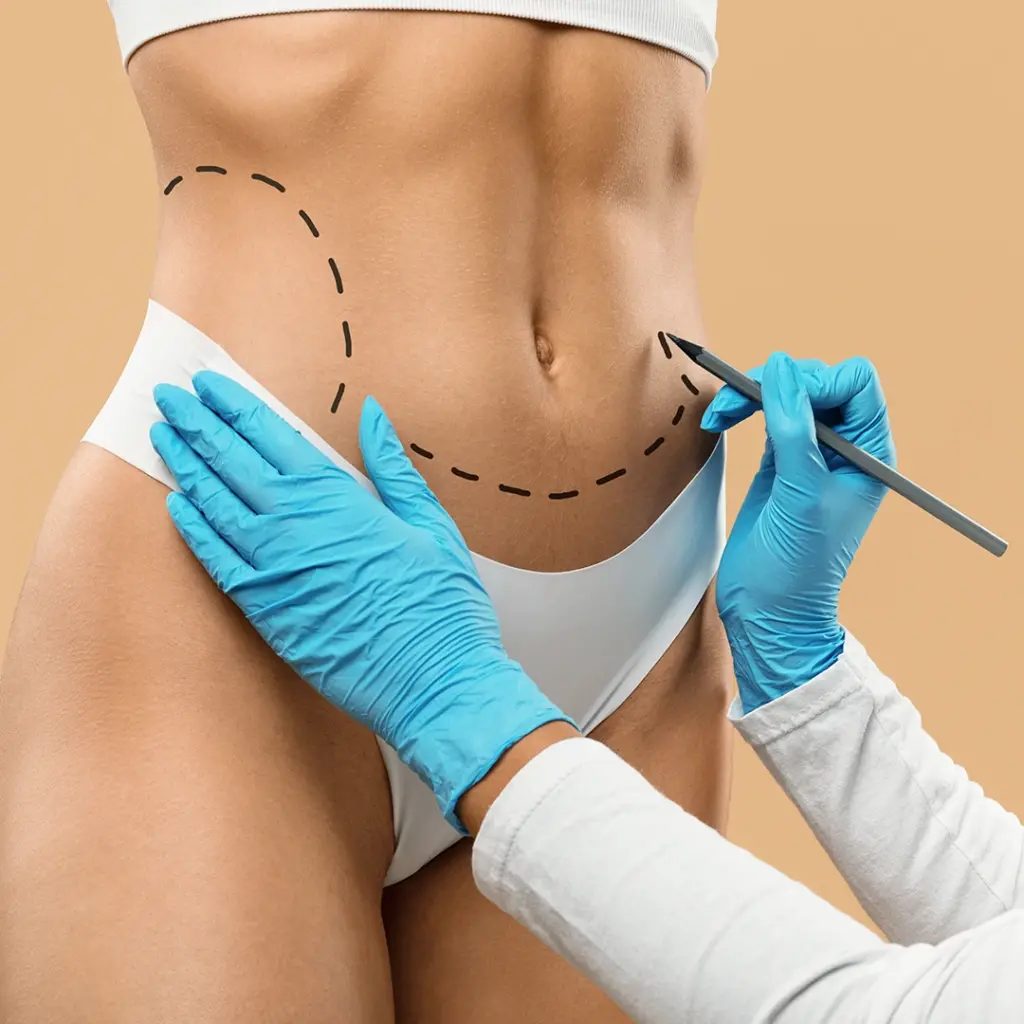 Abdominoplastie