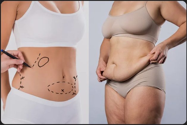 Abdominoplastie