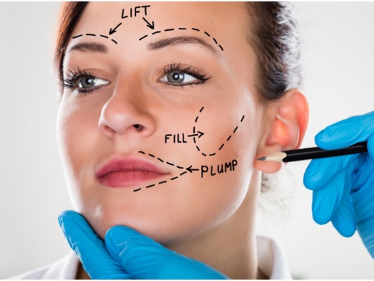 Lifting du visage